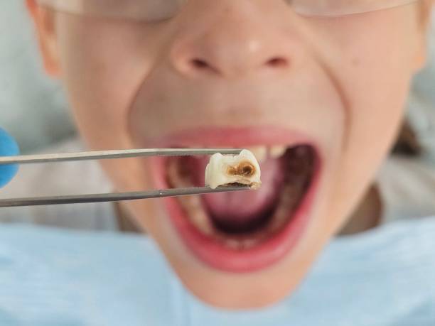Best Emergency Dental Care for Broken or Chipped Teeth in Gra Forks Af, ND