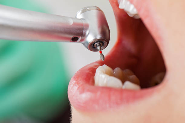 Best Emergency Tooth Extraction in Gra Forks Af, ND